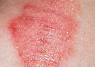 1,急性湿疹的症状:发病迅速,瘙痒剧烈,皮损多形性,红斑,丘疹,丘疱疹